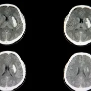 IStock 1056146830 Intracerebral Hemorrhage