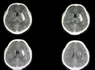IStock 1056146830 Intracerebral Hemorrhage