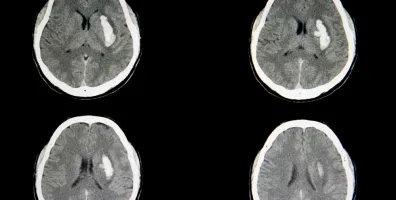 IStock 1056146830 Intracerebral Hemorrhage