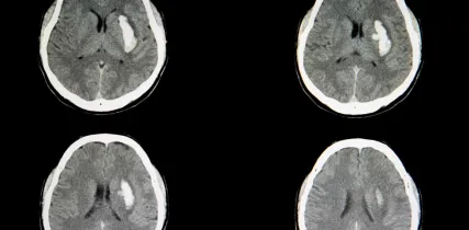 IStock 1056146830 Intracerebral Hemorrhage